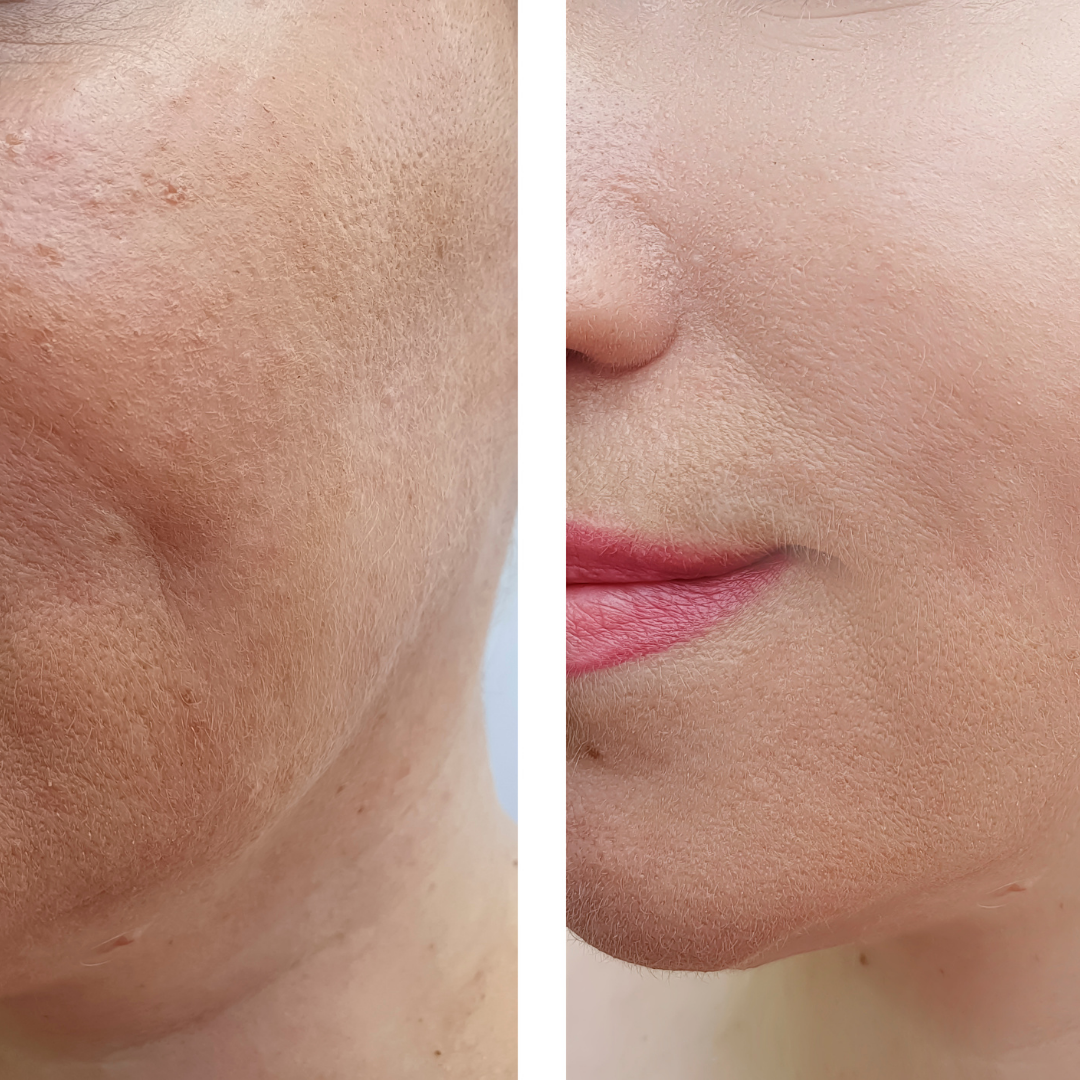 Luminous Mask™ | Rotlicht-Therapie Maske
